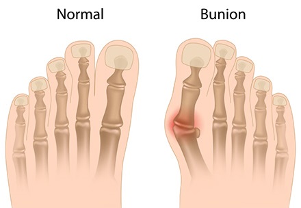 Image of a normal foot and a foot with a bunion