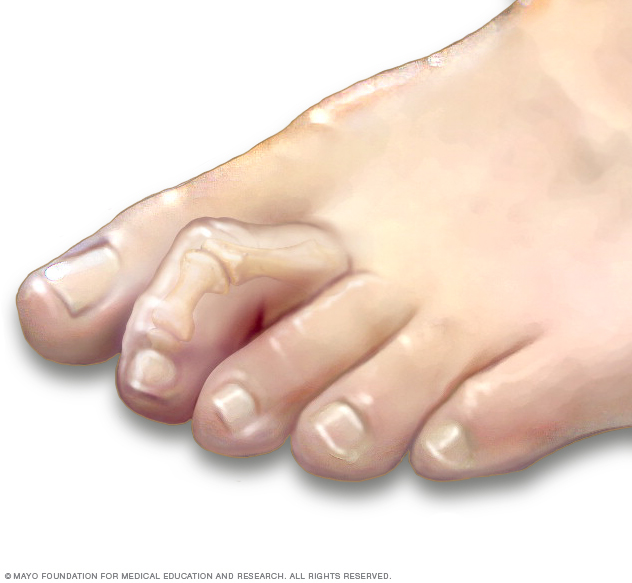 Toe deformity - Foot problems - Clinique de chirurgie du pied de Montréal